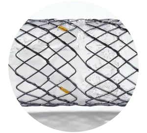 EPF - Parcial coberto com válvula - Hanaro Stent