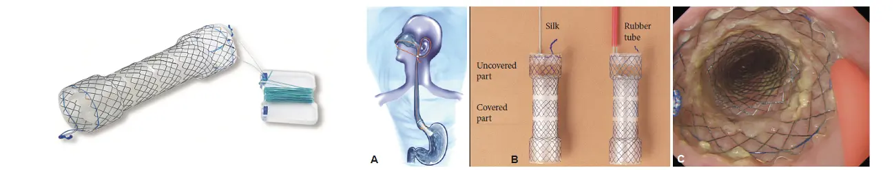 EPG – Parcial coberto com shim - Hanaro Stent