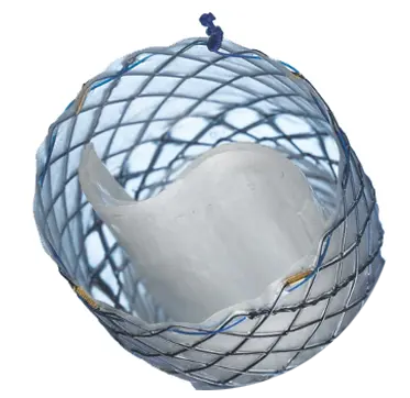 EPF - Parcial coberto com válvula - Hanaro Stent