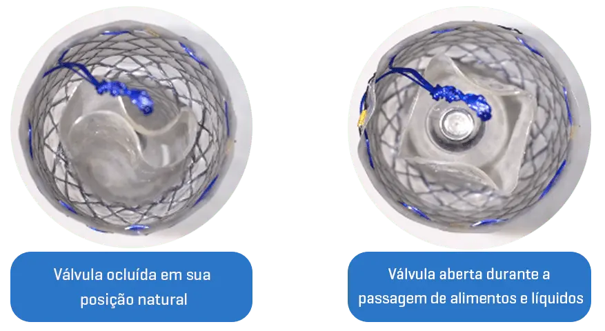 EPF - Parcial coberto com válvula - Hanaro Stent